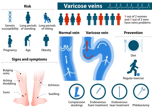 varicose veins chart