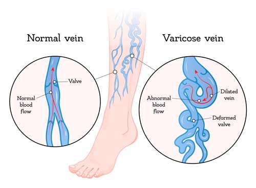 Normal versus varicose vein