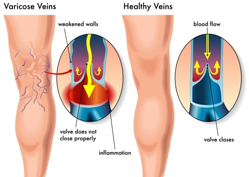 Varicose veins diagram